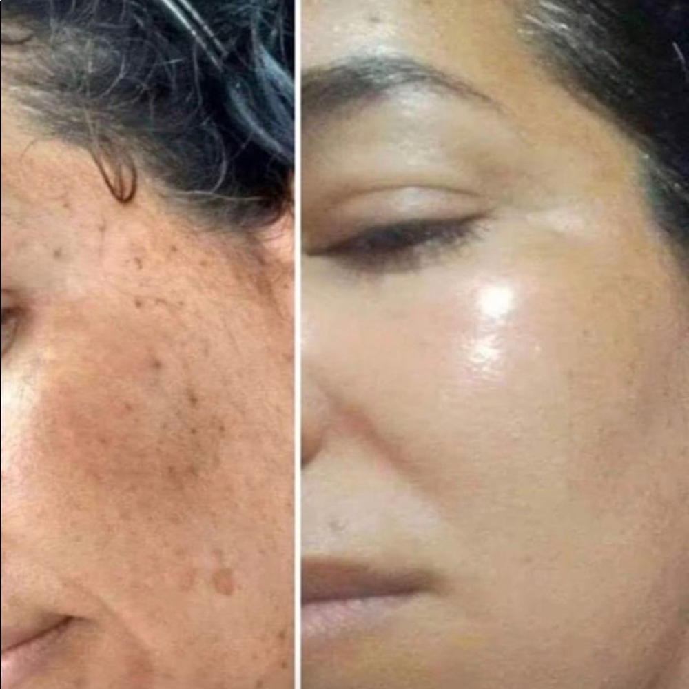 Melasma Whitening Set